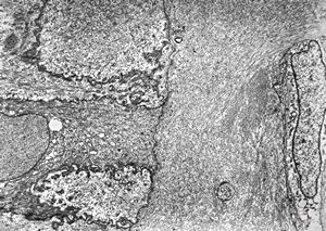 F,2d. | undefined hereditary syndrome, multiplied anomalies, sibling Acornea - keratopathy … missing Bowman membrane, disorganized stromal architecture